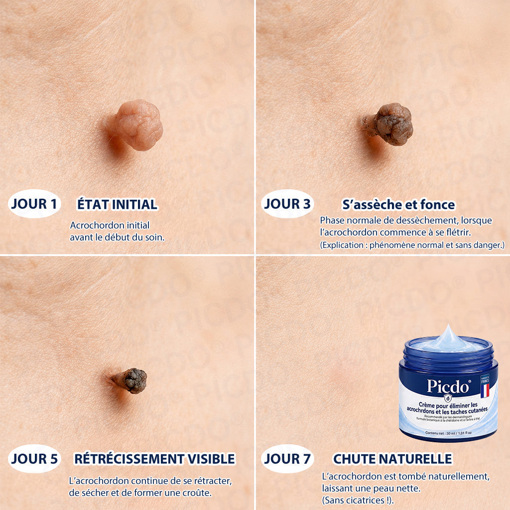 𝐏𝐢𝐜𝐝𝐨® 𝐂𝐫𝐞𝐦𝐞 𝐜𝐨𝐫𝐫𝐞𝐜𝐭𝐫𝐢𝐜𝐞 𝐩𝐨𝐮𝐫 𝐚𝐜𝐫𝐨𝐜𝐡𝐨𝐫𝐝𝐨𝐧𝐬 𝐞𝐭 𝐭𝐚𝐜𝐡𝐞𝐬 𝐜𝐮𝐭𝐚𝐧é𝐞𝐬 (Formule indolore et sans cicatrice) 🎉
