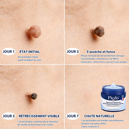 𝐏𝐢𝐜𝐝𝐨® 𝐂𝐫𝐞𝐦𝐞 𝐜𝐨𝐫𝐫𝐞𝐜𝐭𝐫𝐢𝐜𝐞 𝐩𝐨𝐮𝐫 𝐚𝐜𝐫𝐨𝐜𝐡𝐨𝐫𝐝𝐨𝐧𝐬 𝐞𝐭 𝐭𝐚𝐜𝐡𝐞𝐬 𝐜𝐮𝐭𝐚𝐧é𝐞𝐬 (Formule indolore et sans cicatrice) 🎉