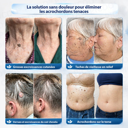 𝐏𝐢𝐜𝐝𝐨® 𝐂𝐫𝐞𝐦𝐞 𝐜𝐨𝐫𝐫𝐞𝐜𝐭𝐫𝐢𝐜𝐞 𝐩𝐨𝐮𝐫 𝐚𝐜𝐫𝐨𝐜𝐡𝐨𝐫𝐝𝐨𝐧𝐬 𝐞𝐭 𝐭𝐚𝐜𝐡𝐞𝐬 𝐜𝐮𝐭𝐚𝐧é𝐞𝐬 (Formule indolore et sans cicatrice) 🎉