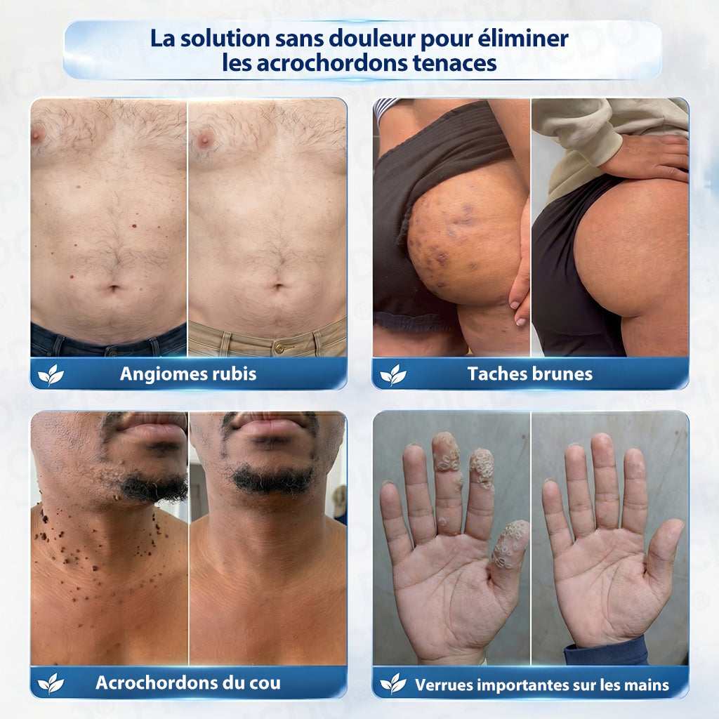𝐏𝐢𝐜𝐝𝐨® 𝐂𝐫𝐞𝐦𝐞 𝐜𝐨𝐫𝐫𝐞𝐜𝐭𝐫𝐢𝐜𝐞 𝐩𝐨𝐮𝐫 𝐚𝐜𝐫𝐨𝐜𝐡𝐨𝐫𝐝𝐨𝐧𝐬 𝐞𝐭 𝐭𝐚𝐜𝐡𝐞𝐬 𝐜𝐮𝐭𝐚𝐧é𝐞𝐬 (Formule indolore et sans cicatrice) 🎉