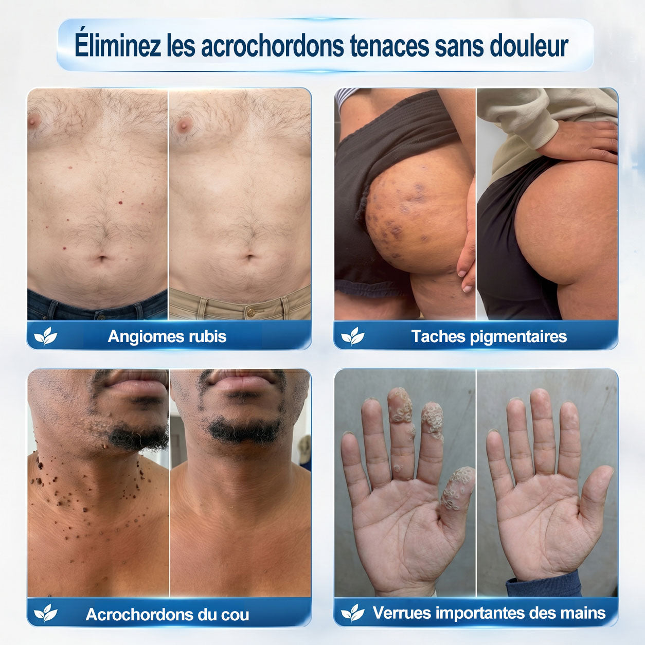 𝐏𝐢𝐜𝐝𝐨® 𝐒𝐨𝐥𝐮𝐭𝐢𝐨𝐧 𝐜𝐢𝐛𝐥é𝐞 𝟕 𝐣𝐨𝐮𝐫𝐬 𝐩𝐨𝐮𝐫   𝐚𝐜𝐫𝐨𝐜𝐡𝐨𝐫𝐝𝐨𝐧𝐬 𝐞𝐭 𝐢𝐦𝐩𝐞𝐫𝐟𝐞𝐜𝐭𝐢𝐨𝐧𝐬(Roll-on indolore et sans trace) ❤️