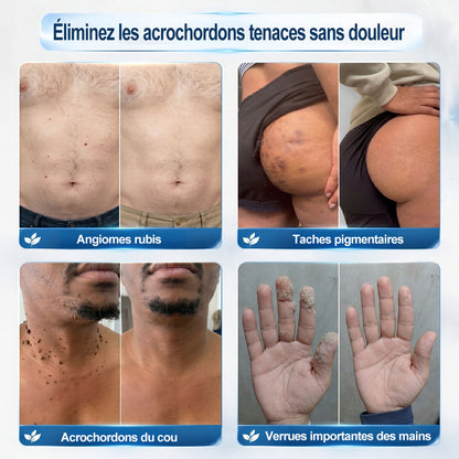 𝐏𝐢𝐜𝐝𝐨® 𝐒𝐨𝐥𝐮𝐭𝐢𝐨𝐧 𝐜𝐢𝐛𝐥é𝐞 𝟕 𝐣𝐨𝐮𝐫𝐬 𝐩𝐨𝐮𝐫   𝐚𝐜𝐫𝐨𝐜𝐡𝐨𝐫𝐝𝐨𝐧𝐬 𝐞𝐭 𝐢𝐦𝐩𝐞𝐫𝐟𝐞𝐜𝐭𝐢𝐨𝐧𝐬(Roll-on indolore et sans trace) ❤️