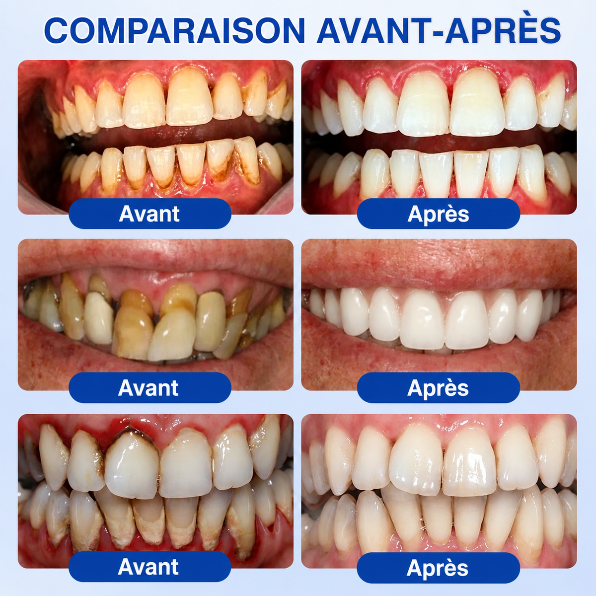 🇫🇷 𝑮𝒍𝒊𝒎𝒎𝒆𝒓𝒍𝒚® 🧑‍⚕️ 𝑮𝒖𝒎𝑹𝒆𝒗𝒊𝒗𝒆 𝑮𝒆𝒍 𝒅𝒆 𝑹é𝒑𝒂𝒓𝒂𝒕𝒊𝒐𝒏 𝑷𝒂𝒓𝒐𝒅𝒐𝒏𝒕𝒂𝒍𝒆 ❤️