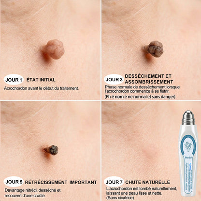 𝐏𝐢𝐜𝐝𝐨® 𝐒𝐨𝐥𝐮𝐭𝐢𝐨𝐧 𝐜𝐢𝐛𝐥é𝐞 𝟕 𝐣𝐨𝐮𝐫𝐬 𝐩𝐨𝐮𝐫   𝐚𝐜𝐫𝐨𝐜𝐡𝐨𝐫𝐝𝐨𝐧𝐬 𝐞𝐭 𝐢𝐦𝐩𝐞𝐫𝐟𝐞𝐜𝐭𝐢𝐨𝐧𝐬(Roll-on indolore et sans trace) ❤️